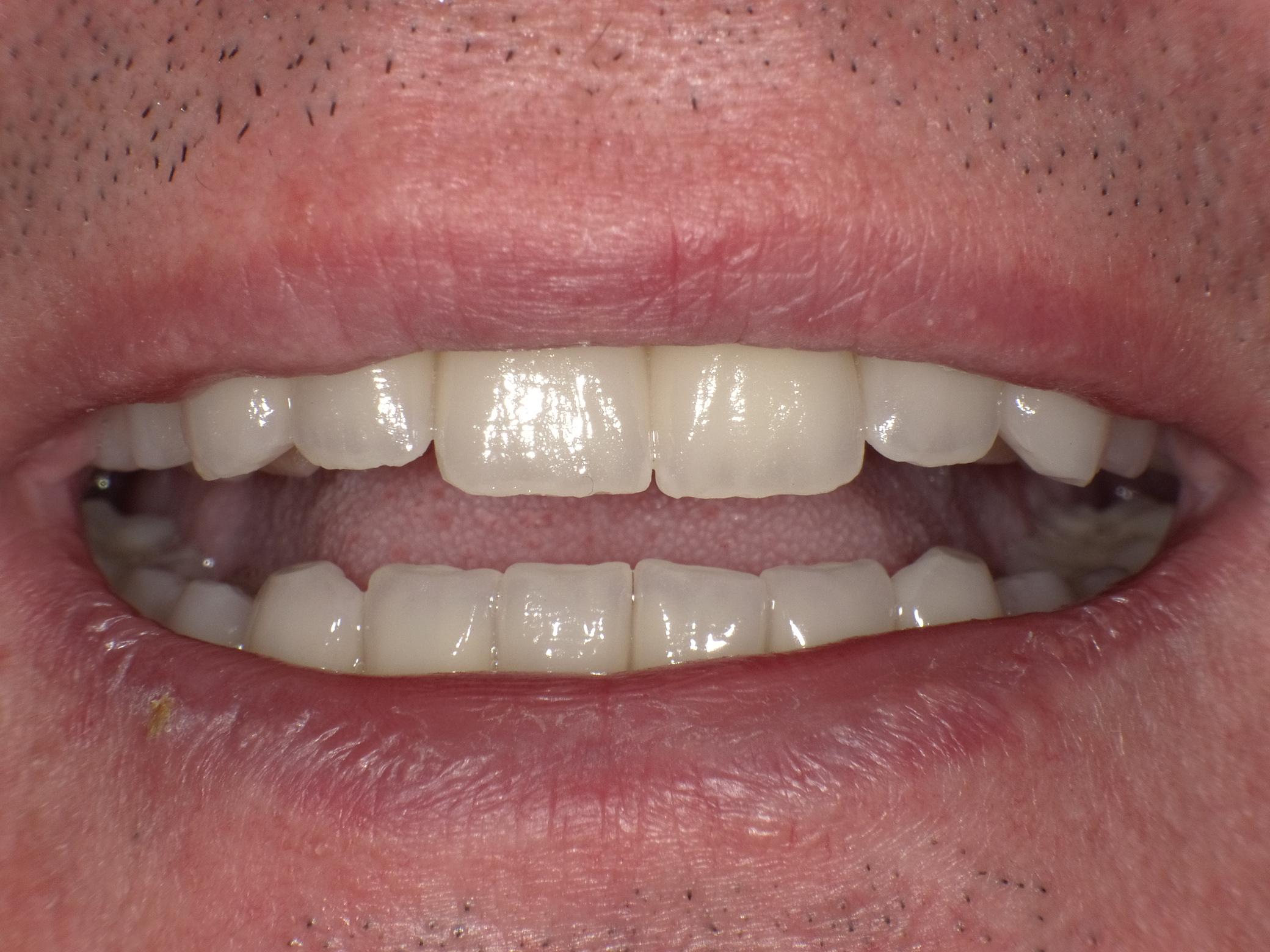 Kompletterneuerung mit vollkeramischen Veneers und Kronen; vorher Endo-Revisionen unter dem Mikroskop und PAR-Behandlung; Entfernung der Weisheitszähne in unserer Praxis